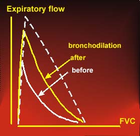 Flow-volume curve prior to and post bronchodilator drug in severe asthma