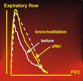 Flow-volume curve prior to and post bronchodilator drug in severe asthma